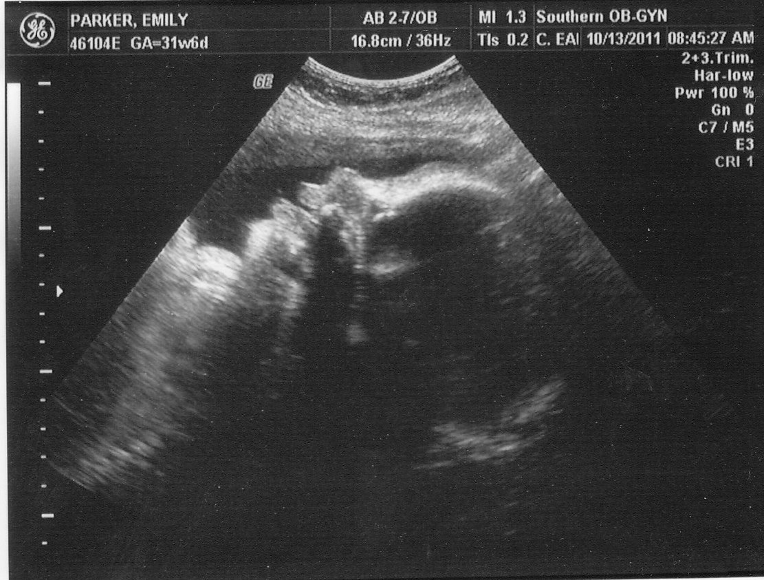 ultrasound report at 32 weeks