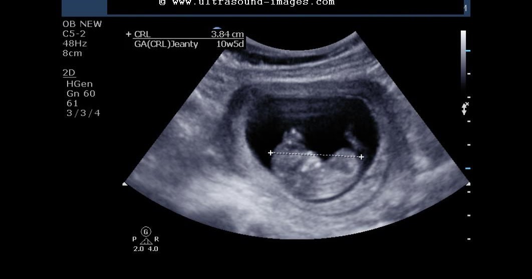 Ultrasound imaging Fetal 3Dultrasound images at 10 weeks