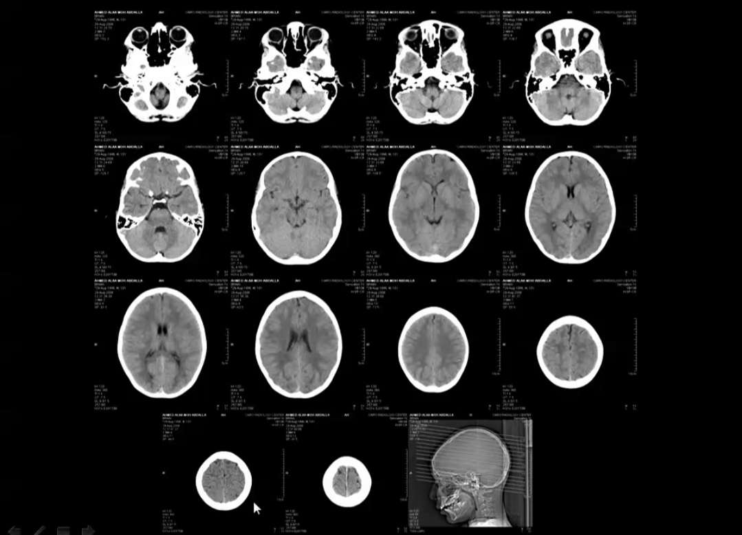 case study Normal CT brain How to report