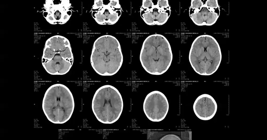 case study :: Normal CT brain :: How to report