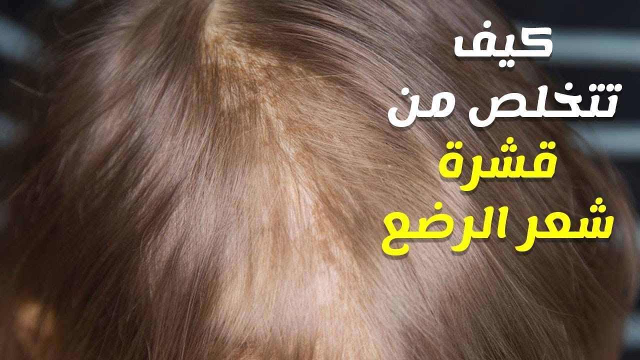 أسباب قشرة الشعر عند الأطفال أسباب قشرة الشعر عند الأطفال