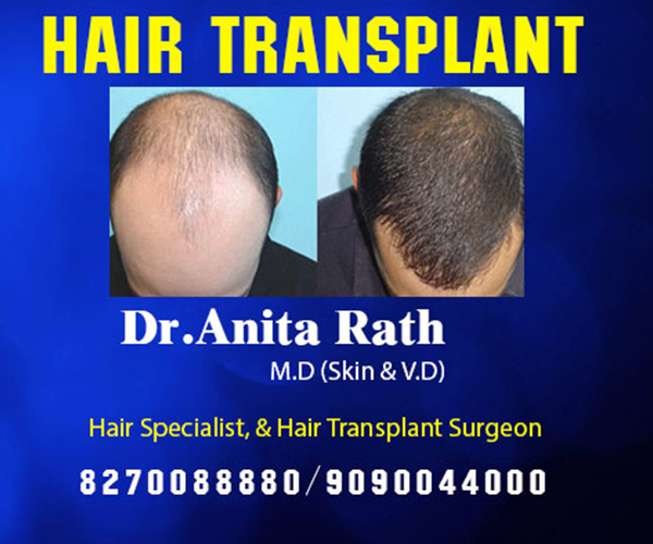 Best hair transplant clinic in Bhubaneswar Hair transplant Doctor in