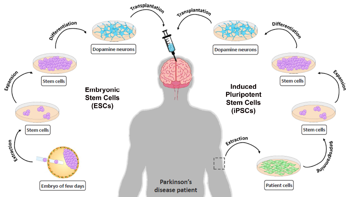 Our Parkinson's Place End of the Road for Fetal Neuron Transplant in