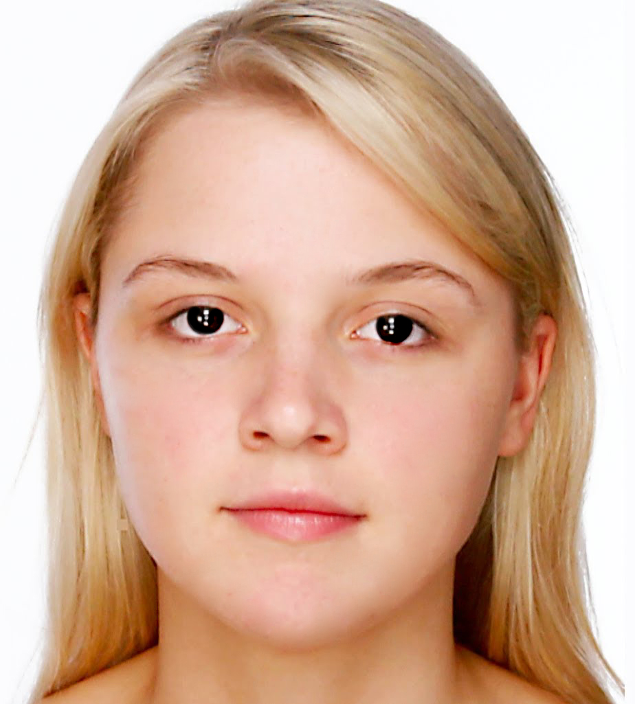 Лицо девушки с проблемной кожей. Лицо подавшее ранее. Лицо подавшее ранее. Лицо до и после наркотиков. Девушка с проблемной кожей.