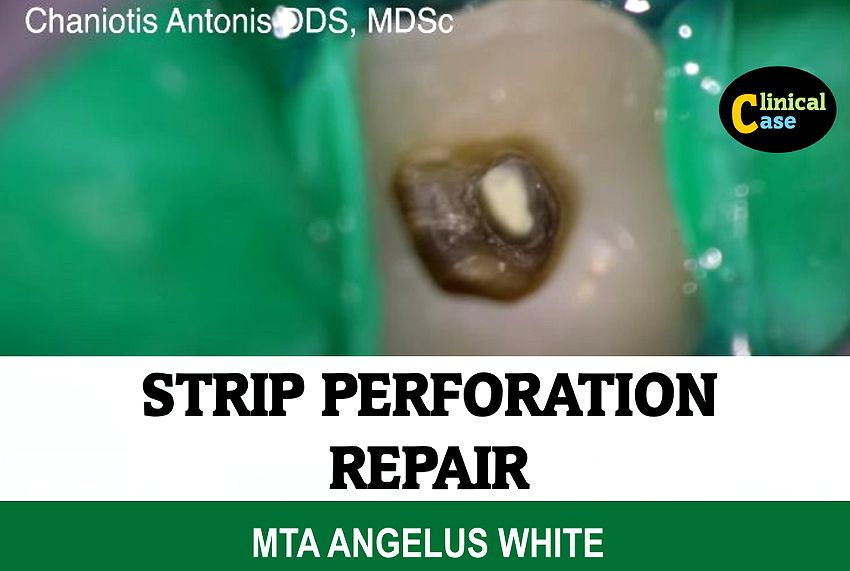 ENDODONTIC COMPLICATIONS Strip perforation repair with MTA angelus white