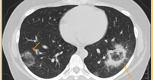 симптом гало. симптом ореола на кт легких. признаком обратного «гало». симптом обратного гало на кт легких. симптом обратного ореола на кт легких.