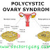 Getting fat day by day, aren't you suffering from Polycystic ovarian syndrome?