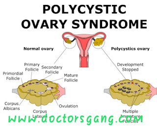 Polycystic ovary vs Normal ovary and PCOS