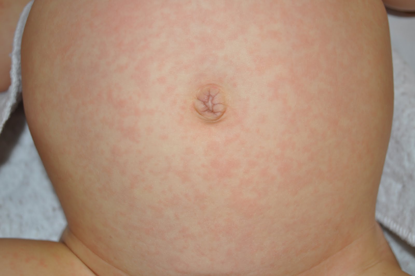 roseola in toddler