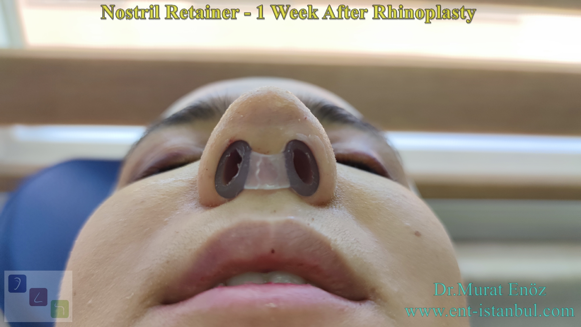 About The Nostril Retainer