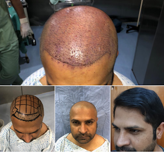 Hair Transplant in Lahore, FUE, FUT Hair Tranpslant In Lahore. See plastic surgery before and after results