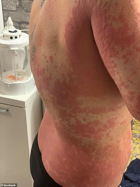 Shocking Photos of a Mom as she Suffers Rash All Over her body after taking the AstraZeneca Vaccine