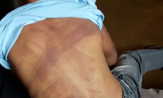 Menino de 4 anos é espancado pela mãe e pelo padrasto em Rondominas e Jaru Menino de 4 anos é espancado pela mãe e pelo padrasto em Rondominas e Jaru