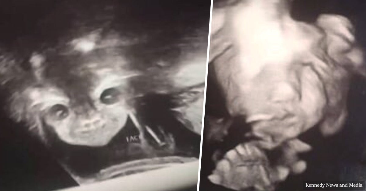 Staring ‘Devil Baby’ In Pregnancy Scan Scares A Young Mother To Be