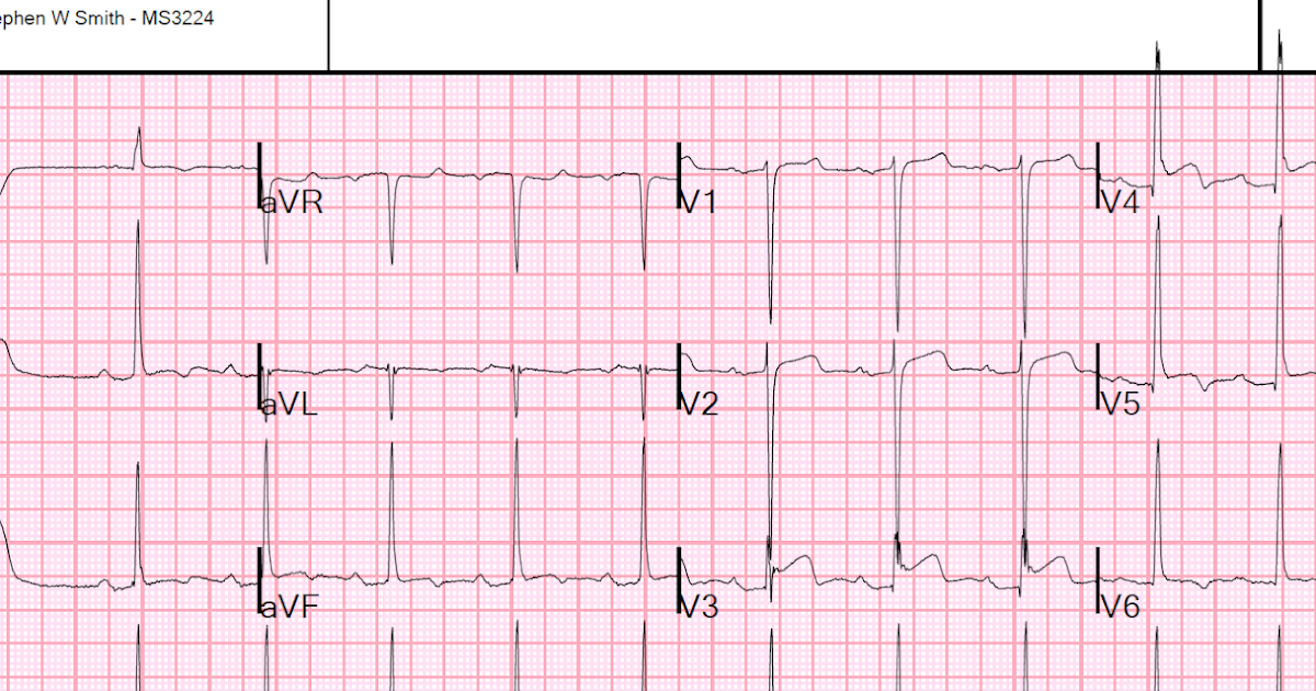 экг признаки депрессия st. депрессия st в отведениях v2-v6. экг депрессия сегмента. снижение сегмента st на экг. депрессия сегмента st до 2мм.