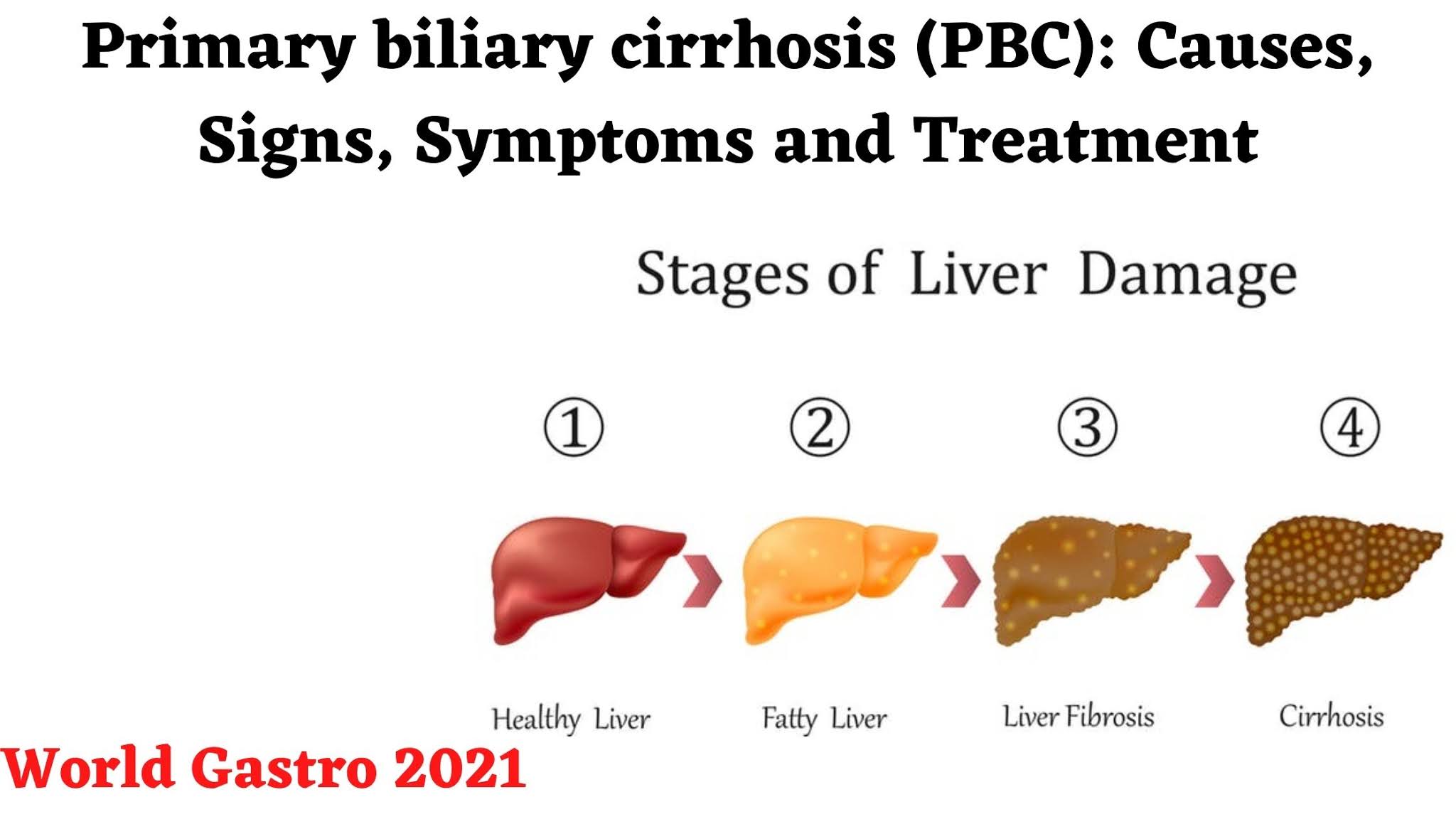Primary biliary cirrhosis (PBC): Causes, Signs, Symptoms and Treatment