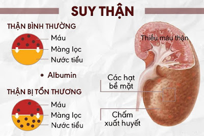 Câu hỏi lâm sàng về suy thận mạn và hội chứng thận hư