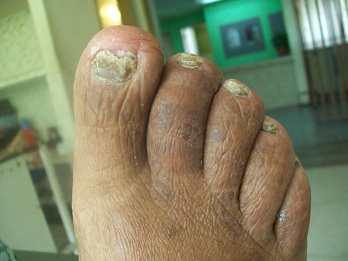 PENYAKIT DERMATOFITOSIS, JENIS, GEJALA DAN PENGOBATAN - WAWASANKU