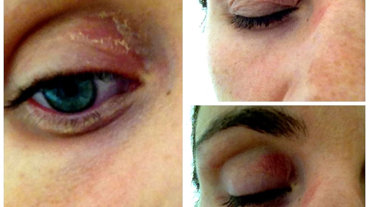 Nickel Allergy Treatment - Treat Choices