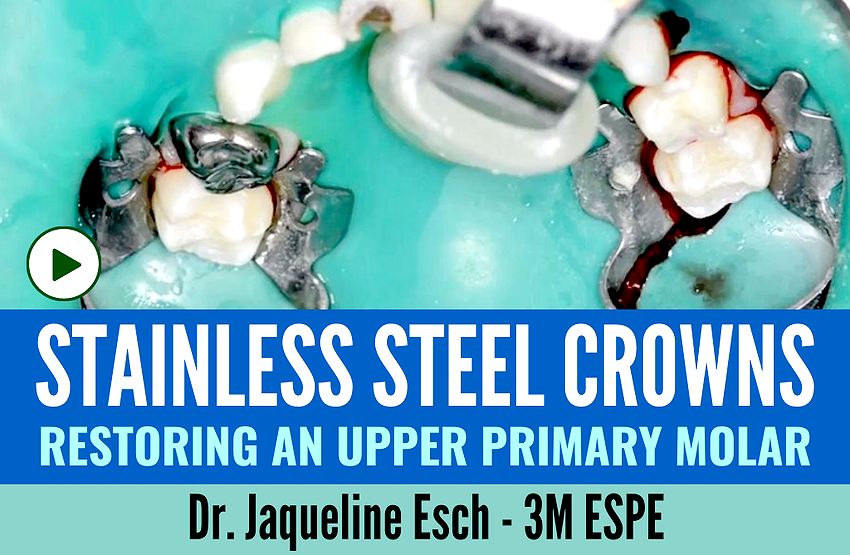 STAINLESS STEEL CROWNS Restoring an upper primary molar Dr