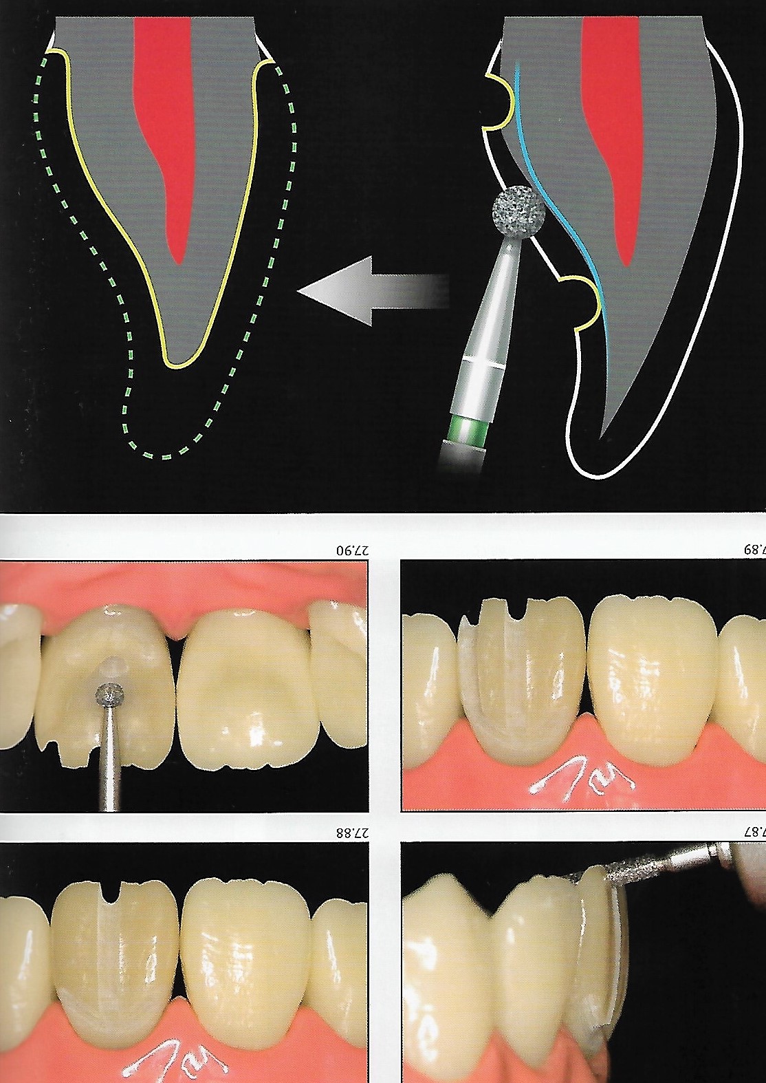 Anterior Crown Preparation Dental Esthetics