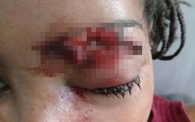 Estudante perde a visão após ser atingida por bala de borracha em Senhor do Bonfim