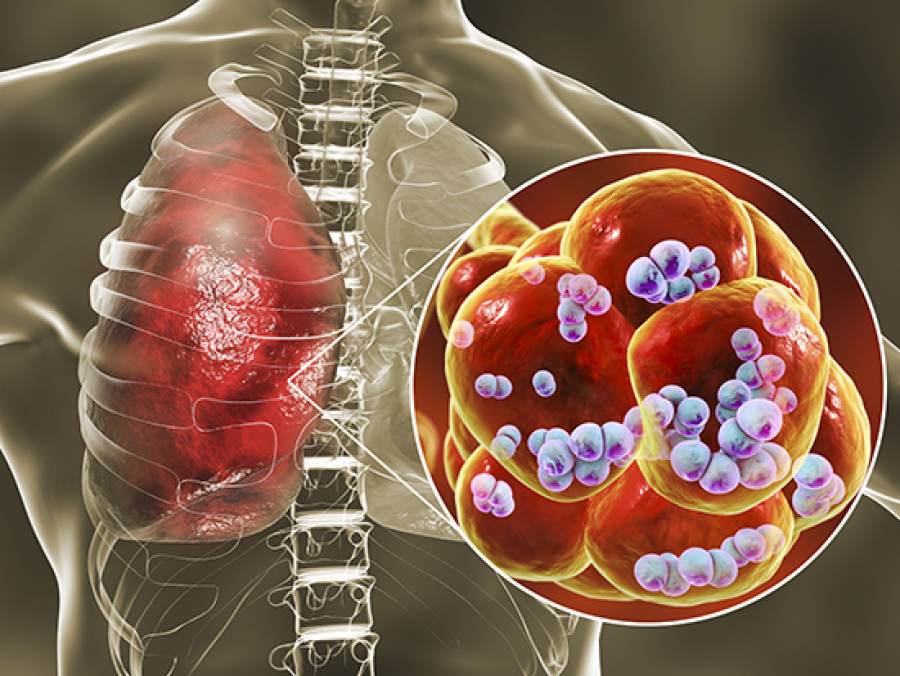 Metastatic Lungs Cancer An Overview