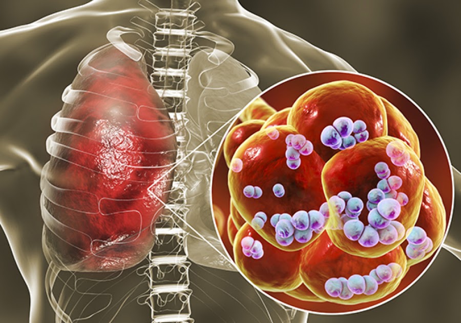 Metastatic Lung's Cancer An overview