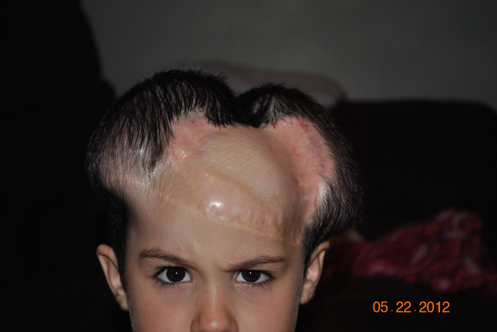 Age 4 Female Scalp Tissue Expanders Twentieth Filling