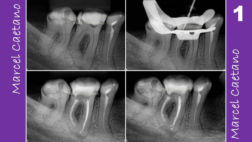 Endodontia Avançada Um pouco sobre Anatomia do Canal, Forame Apical e