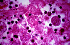 Cerebral malaria thesis 04 picture