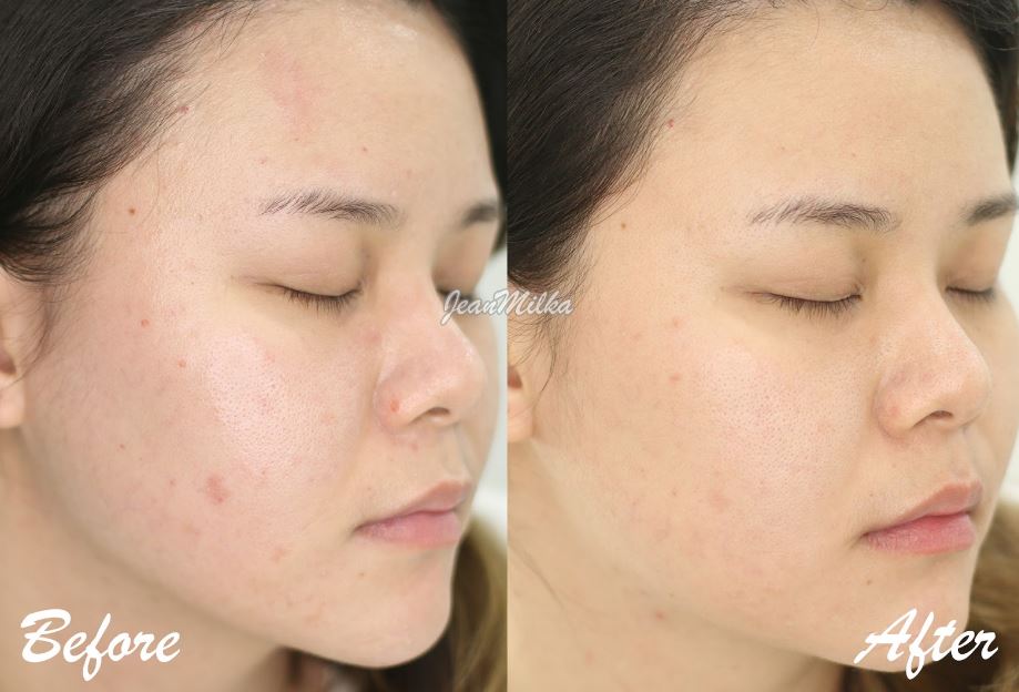 Cara Mengatasi Bekas Jerawat Terbaik dengan Acne Scar Treatment Erha