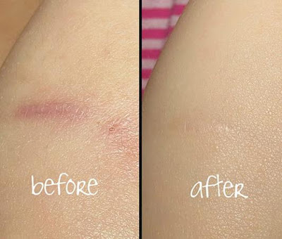Đánh bay sẹo lồi bằng 5 sản phẩm đặc trị sau Đánh bay sẹo lồi bằng 5 sản phẩm đặc trị sau