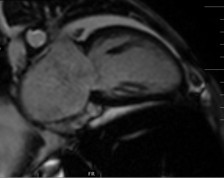 Myocardial Iron EstimationMRI Sumer's Radiology Blog