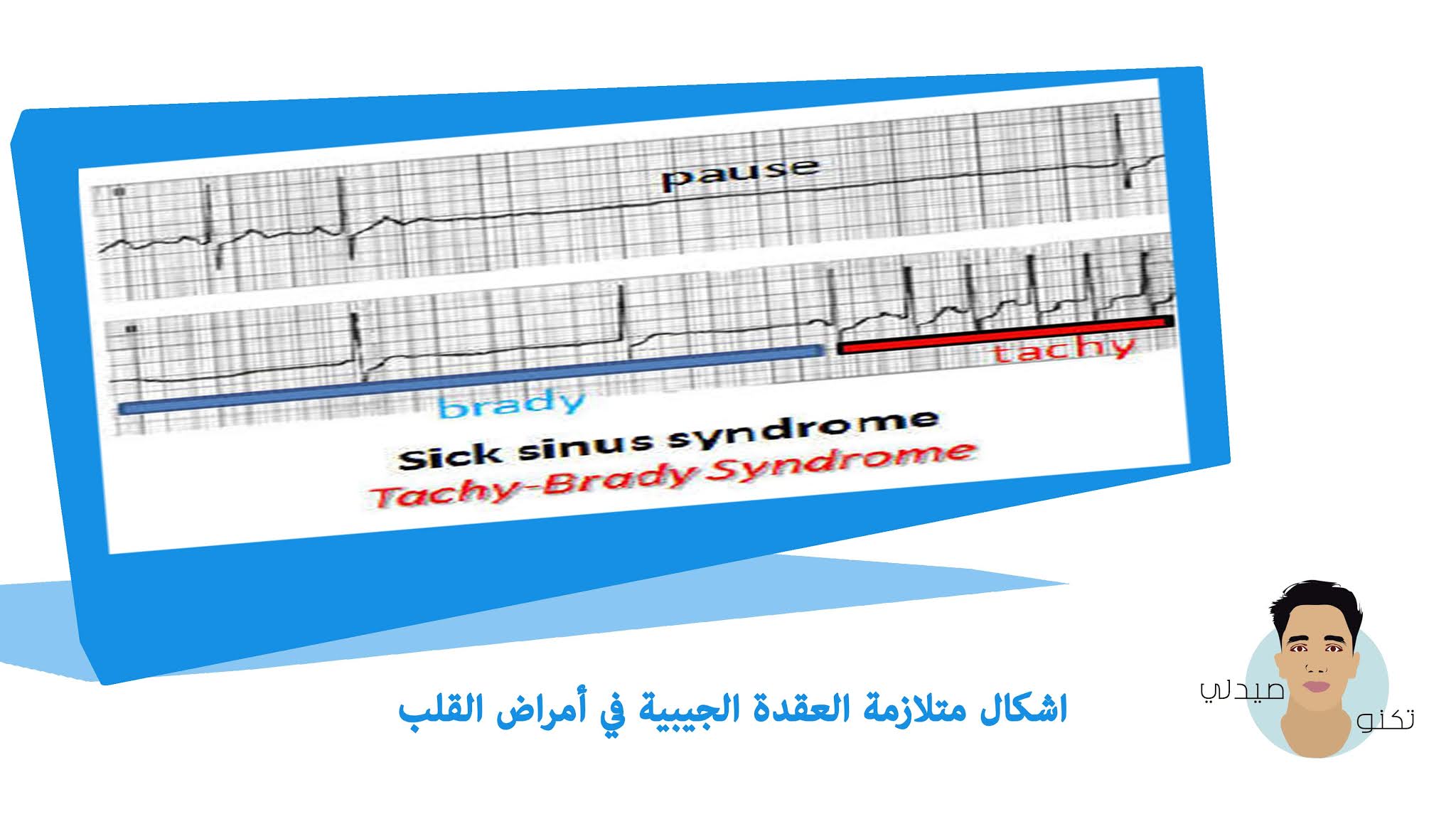 متلازمة العقدة الجيبية في أمراض القلب متلازمة العقدة الجيبية في أمراض القلب
