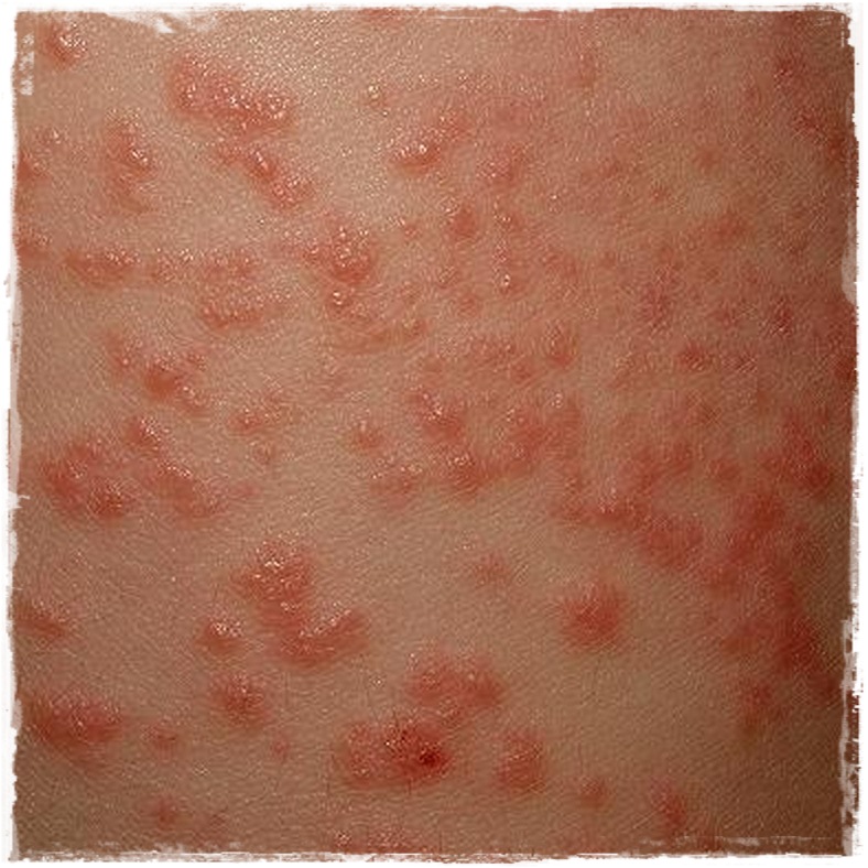 acrodermatitis papular de la infancia