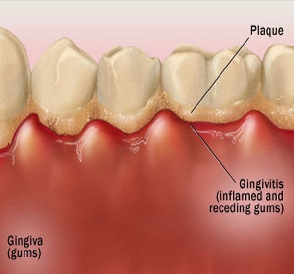 Dentist West Palm Beach Fl Treating Gingivitis