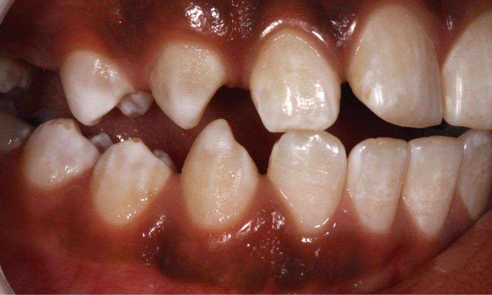 Clinical aspects of dental fluorosis Directorio Odontológico