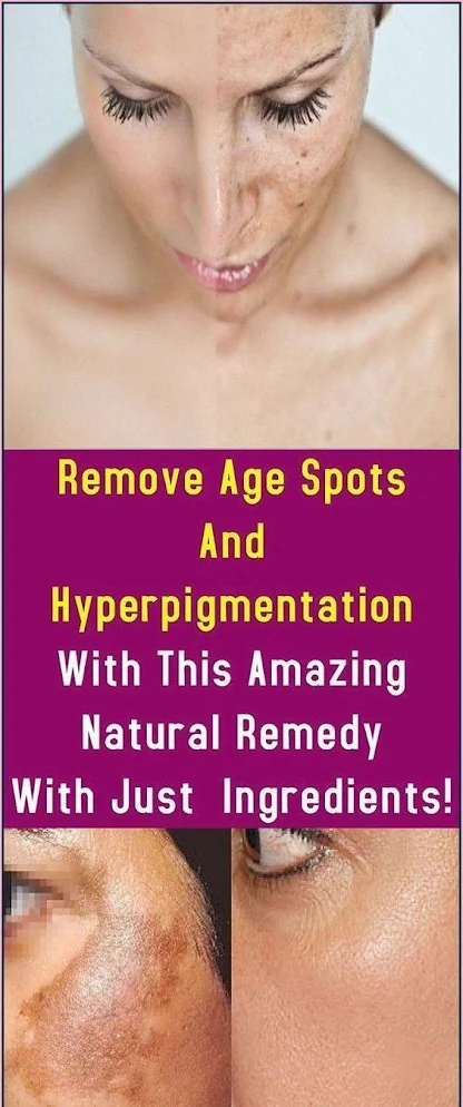 Remove Age Spots And Hyperpigmentation With This Amazing Natural Remedy With Just 2 Ingredients!