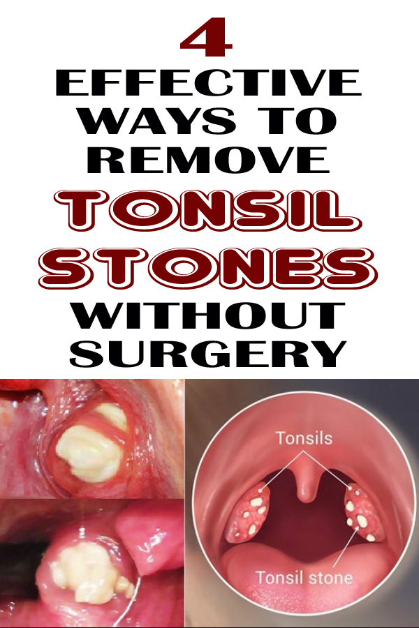 4 Effective Ways To Remove Tonsil Stones Without Surgery