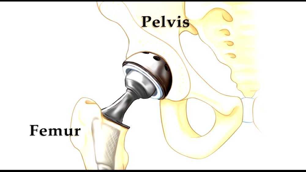 Hip replacement