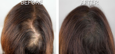 natural solutions for hair loss