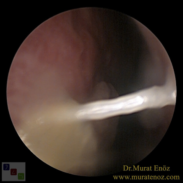 Extracorporeal septum perforation closure in Istanbul - Extracorporeal septum perforation closure in Turkey - Extracorporeal closure of nasal septal perforations subcutaneous tissue - Combining rhinoplasty with extracorporeal septal perforation repair - Repair of nasal septum Perforation