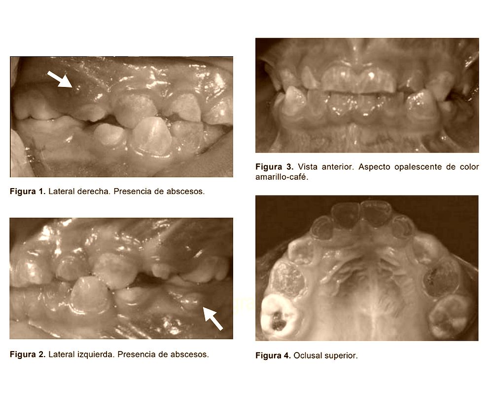 ¿Qué es la Dentinogénesis imperfecta? Reporte de un caso OdontoVida