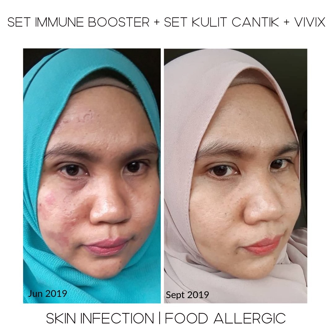 Kesan Sunburn di Muka Hilang Dengan Set Kulit Cantik Shaklee ~ Qiya Beauty