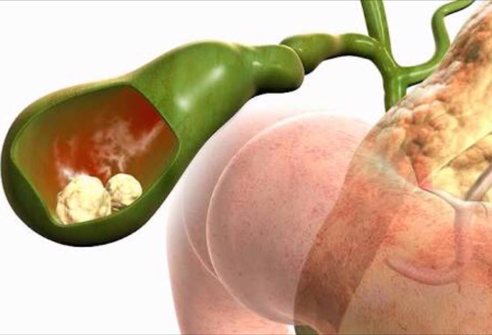 Dr Rogério Perez: Pedra na Vesícula Biliar