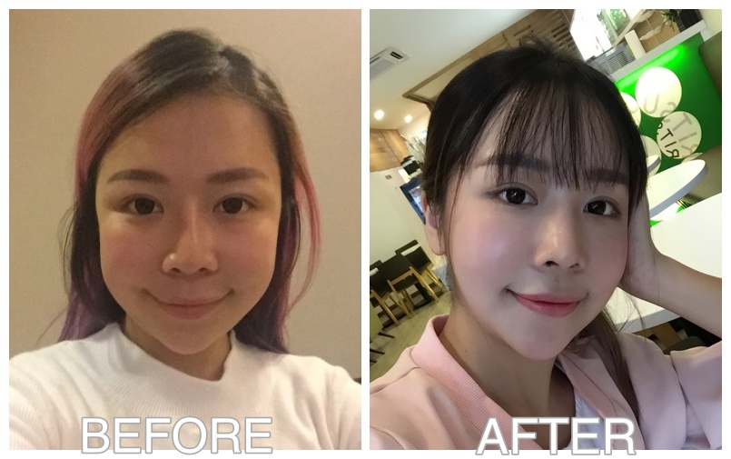 My Plastic Surgery Story In Korea Part 2 Chenelle Wen