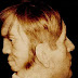 Photo of Edward Mordrake, the man with a second face on the back of his head.
