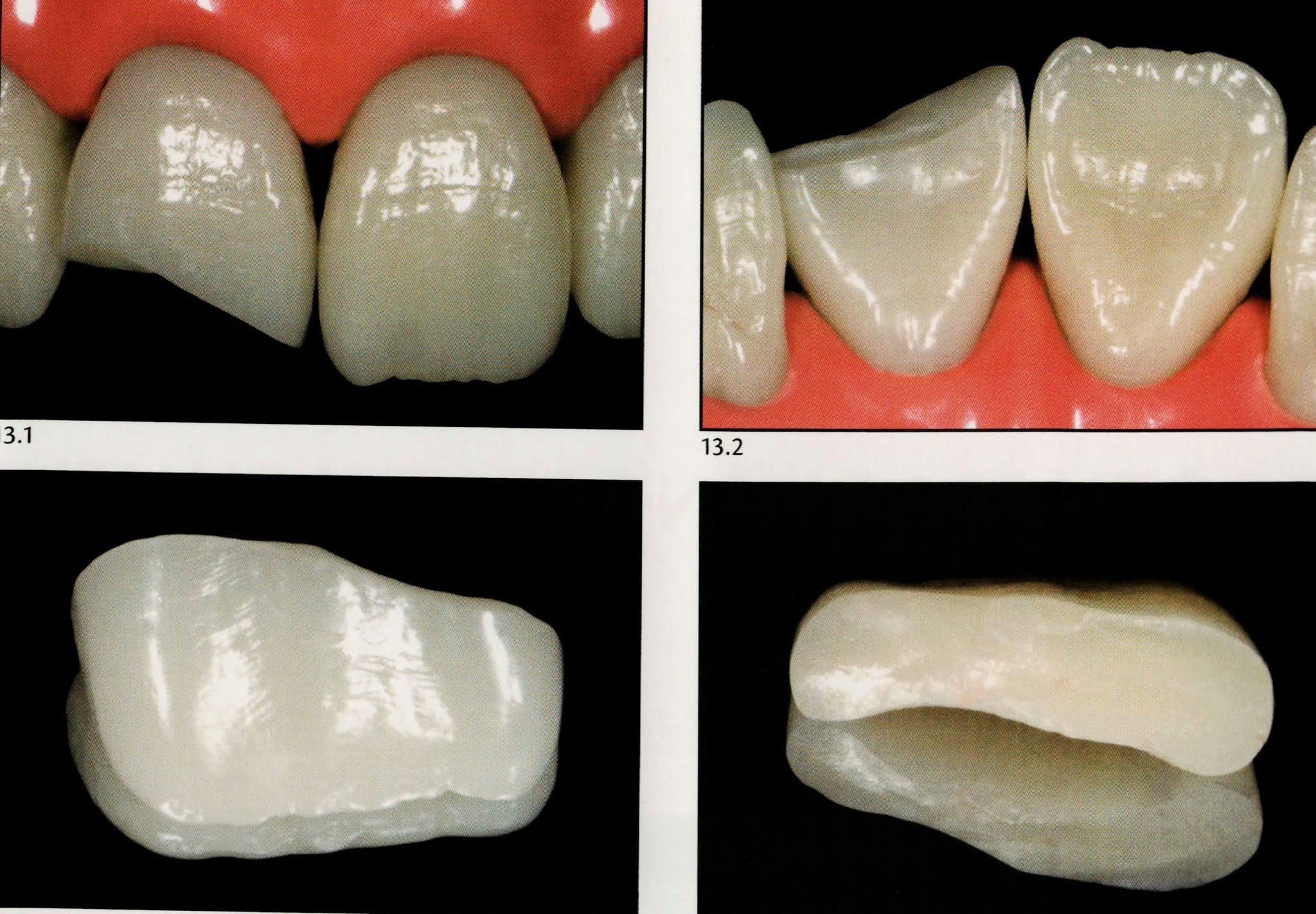 Tooth fragment reattachment Dental Esthetics