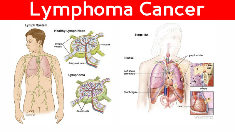 Lymphoma Cancer Image